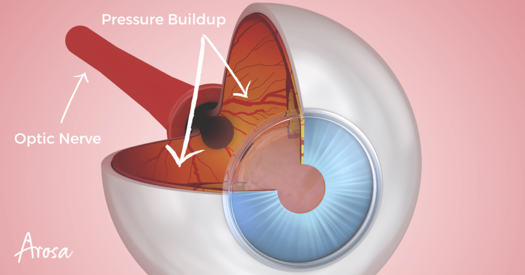 Diagram of an eye highlighting the key areas of the disease glaucoma.