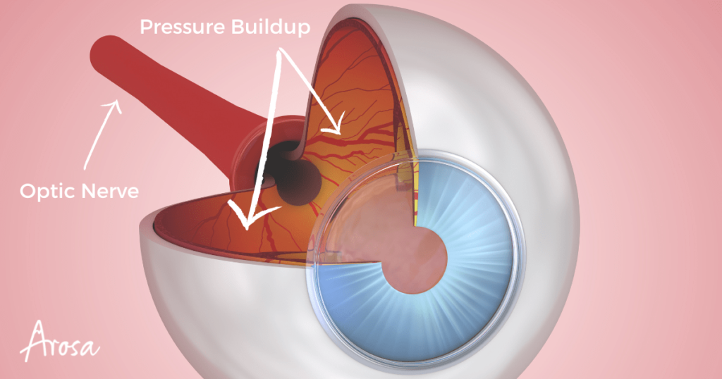 What Is Glaucoma? Symptoms, Causes, Diagnosis, Treatment